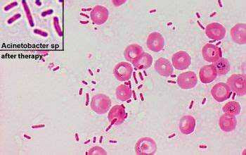 Acinetobacter baumannii