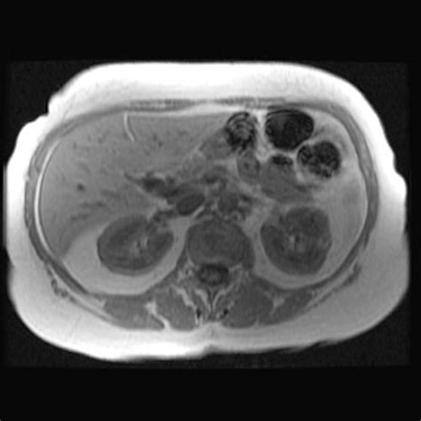 Angiomyolipoma MRI - wikidoc