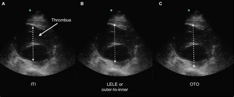 Large Abdominal Aortic Aneurysm