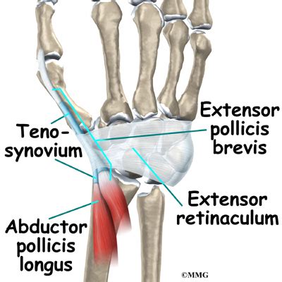 de Quervain's Tenosynovitis - eOrthopod.com