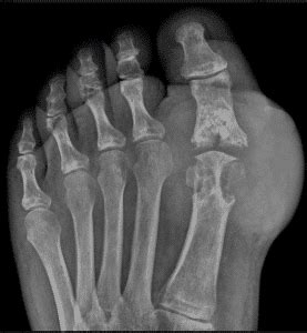 Gout - OC Podiatry