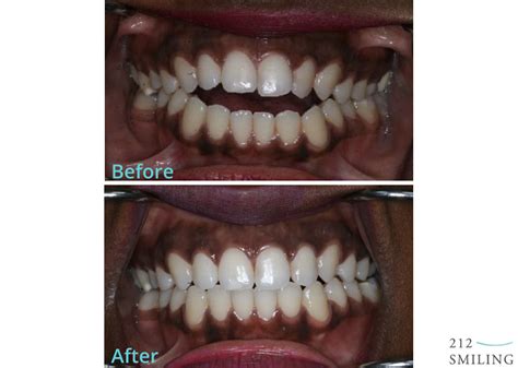 Invisalign Invisible Braces Before and After - 212 Smiling