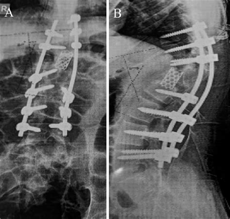 (A) Postoperative AP. X-ray thoracolumbar junction showing coronal... | Download Scientific Diagram