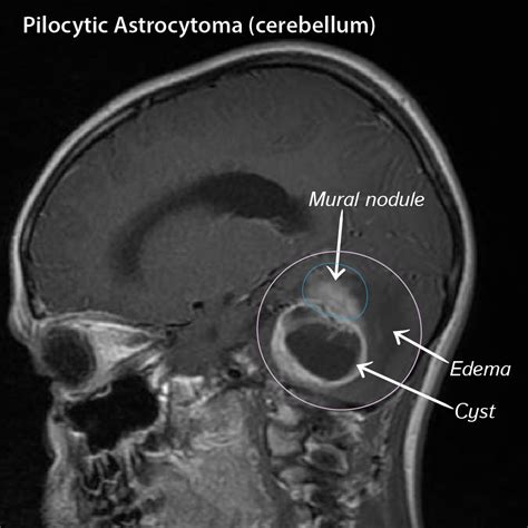 Clinical Pathology Glossary: Pilocytic Astrocytoma | ditki medical ...