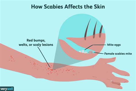 Scabies Prevention