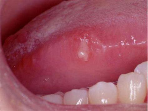 Ulcer on the tongue in children: causes, treatment, prevention