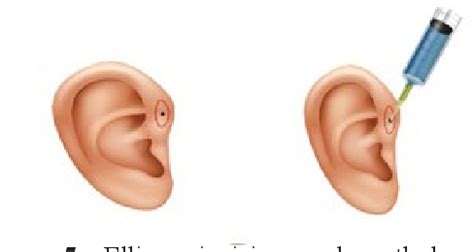 Figure 8 from Surgical management of preauricular fistula based on plastic-reconstructive ...