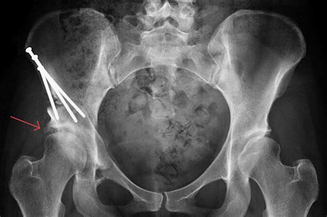 Acetabular dysplasia causes, symptoms, diagnosis, treatment & prognosis