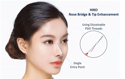 What Are The Advantages And Disadvantages Of Non-Surgical Nose Job? | Dream Plastic Surgery