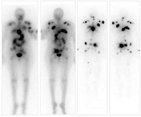 Radioactive Iodine Scan