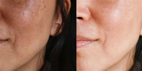 What You Should Know About Melasma, Those Dark Spots on Your Face | SELF