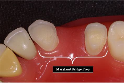 Maryland Bridge | Ask A Dentist