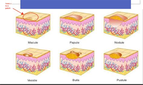 Macule Vs Papule