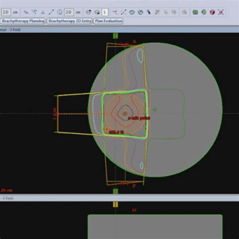 2 Minute Tutorials: 3-Field Wedge Technique Planning – DOSEPEDIA