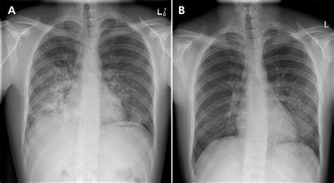 Migratory pulmonary infiltrates | CMAJ