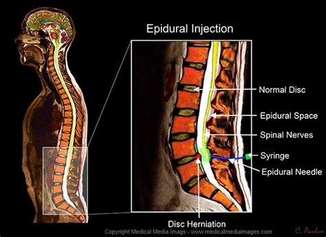 Pin on Color MRI Images of Epidural Injections