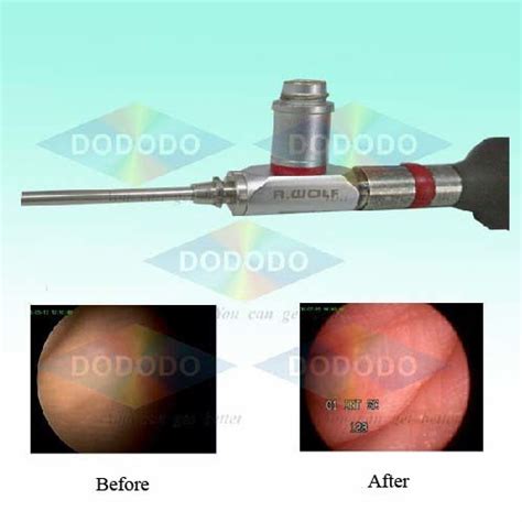 Repair Rigid Endoscope (REPAIR WOLF Series) - China Repair Rigid ...