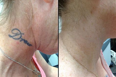 Tattoo Removal Philadelphia Neck -before-after - March 2020 2 - InkAway Laser Tattoo Removal