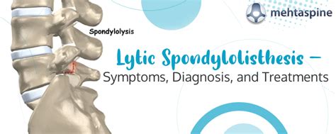 Diagnosis and Treatment of Lytic Spondylolisthesis