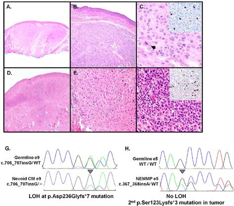 Histologic and molecular analyses of tumors from Fam-562. ( A )–( F ):... | Download Scientific ...