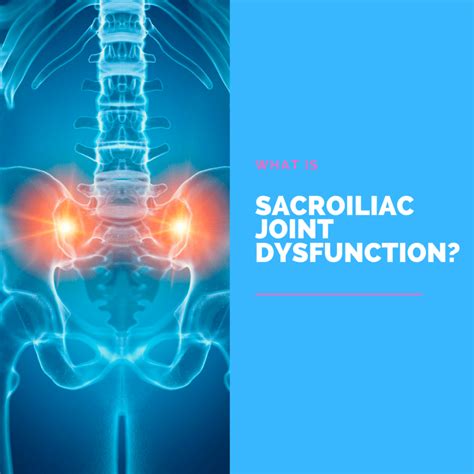 What Is Sacroiliac Joint Dysfunction? | New Jersey | Comprehensive Spine Care