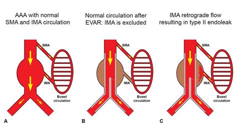 Type II endoleak. A) Schematic representation of an Abdominal Aortic ...