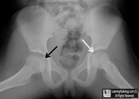 Legg-Calve-Perthes Disease. view of both hips shows a right capital ...