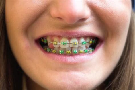 Braces vs Invisalign - Difference and Comparison | Diffen