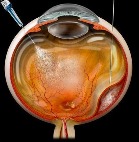 Cornea Disorders and Treatment - Edgbaston Eye Clinic