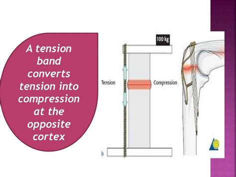 Principle of tension band wiring n its application