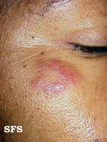 Lymphocytic Infiltration Of The Skin - NC Commons