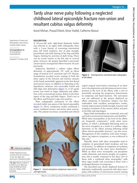 Tardy Ulnar Nerve Palsy Following a Neglected Childhood Lateral - DocsLib