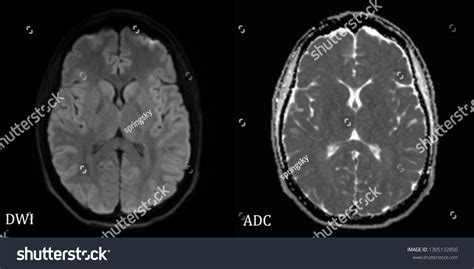 Diffusion Weighted Imaging Normal Brain Mri库存照片1305132850 | Shutterstock