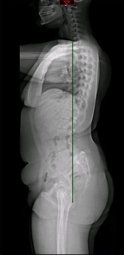 Lumbosacral Spondylolisthesis - StatPearls - NCBI Bookshelf