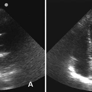 Pericardial effusion three months after pericardial drainage (A: left... | Download Scientific ...