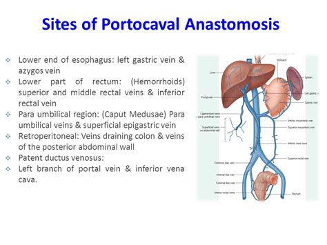 Portacaval Anastomosis Diagram