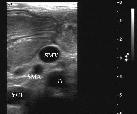 Superior Mesenteric Artery Ultrasound