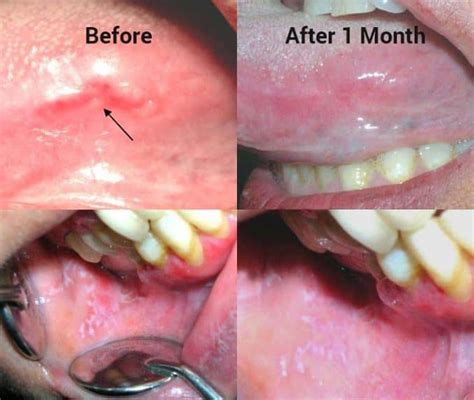 photos of canker sores before and after honey treatment - Superfoodly