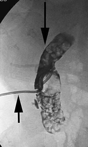 Percutaneous Cholecystostomy | Radiology Key