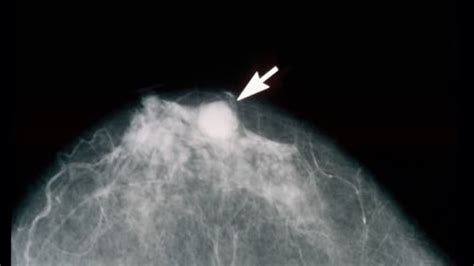 False positive mammogram is real risk factor for breast cancer, study ...