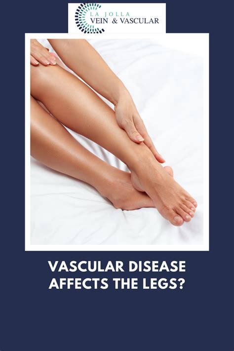 Vein & Vascular Treatment | Vascular Disease & Legs