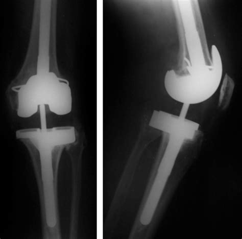 Revision knee replacement - Sudhir Rao - Knee Hip and Shoulder surgeon