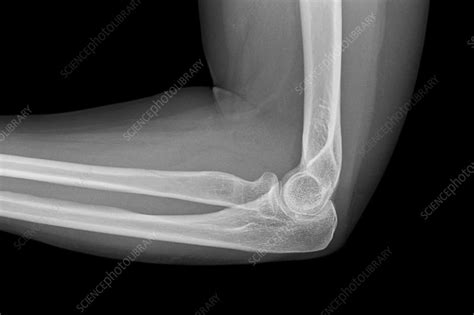 Fracture of elbow bone, X-ray - Stock Image - C038/6689 - Science Photo Library