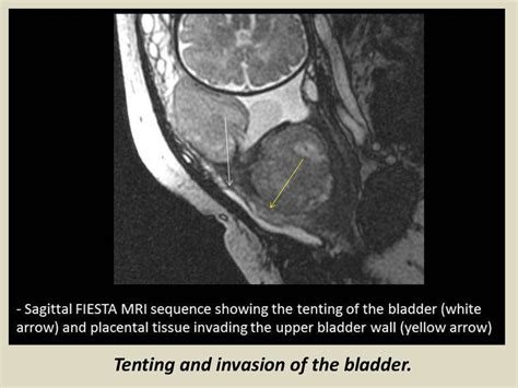 Presentation1, radiological imaging of placenta accreta.