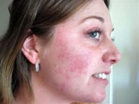 Visit our site http://www.rashonfaceblog.net for more information on Baby Rash On Face.The use ...