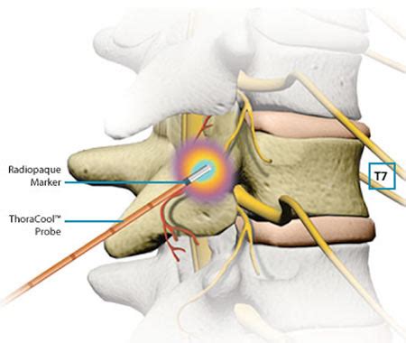 NYC Radiofrequency Ablation Treatment Doctor (Back Pain Specialist ...