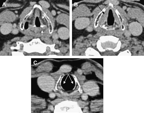 Radiologic Evaluation of Larynx Cancer | Ento Key