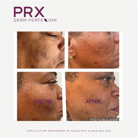 PRX Derm Perfexion | PHDermatology