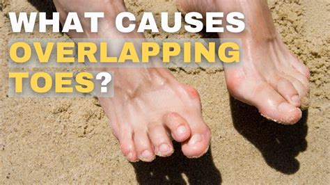 Overlapping Toes: Causes and Solutions - YouTube