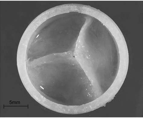 Name of the article | Mr Paget Milsom – Tissue engineered heart valves ...